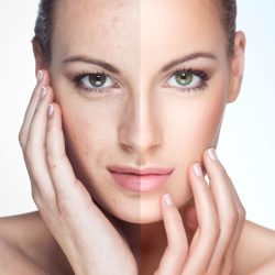 Ipl Skin Rejuvenation